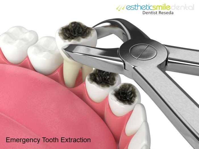 Emergency tooth extraction in Reseda