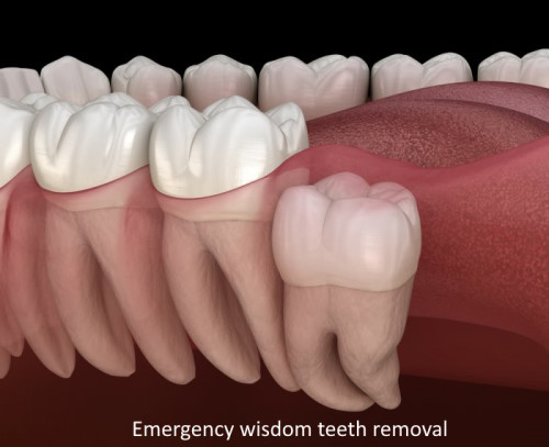 Emergency wisdom teeth removal in Reseda