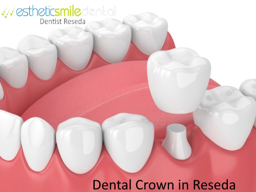 Dental Crowns in Reseda