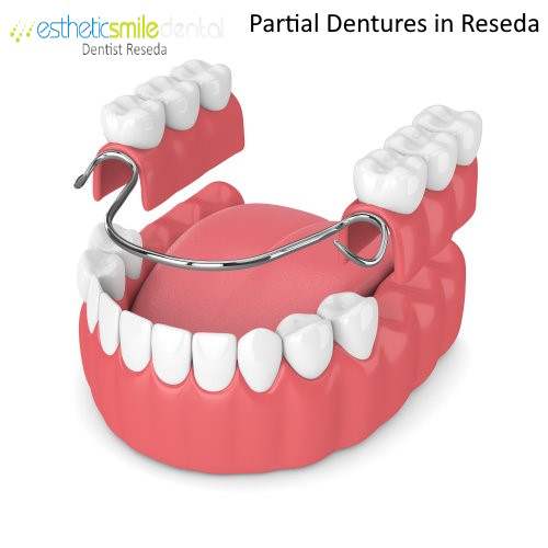 Partial Dentures in Reseda