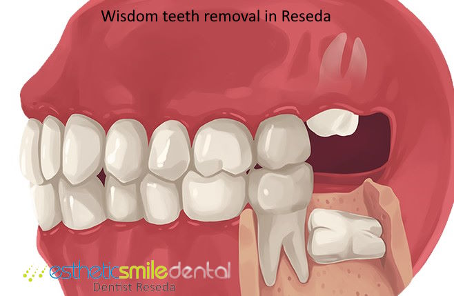 Wisdom Teeth Extraction in Reseda
