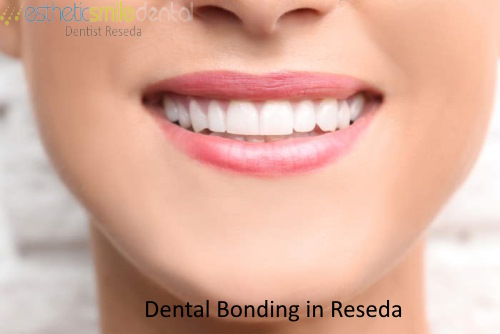 Dr. Jacob Vayner Dental Bonding Provider for Reseda community