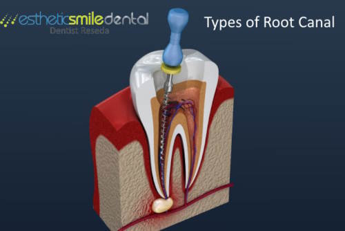 Types of Root Canal Treatment