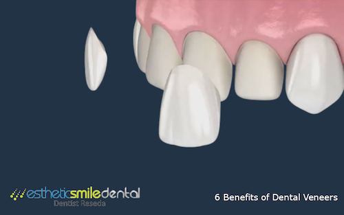 6 Benefits of Dental Veneers
