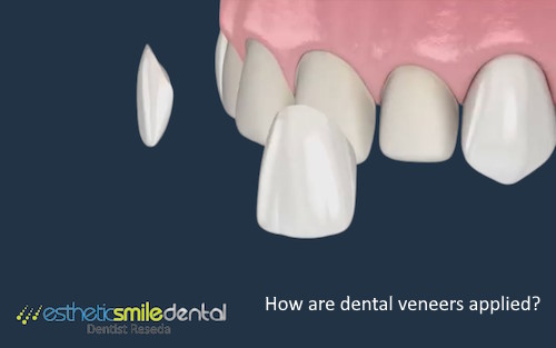 How are Dental Veneers Attached?