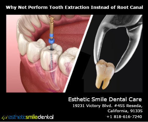 Why Not Extract the Tooth Instead of Performing a Root Canal