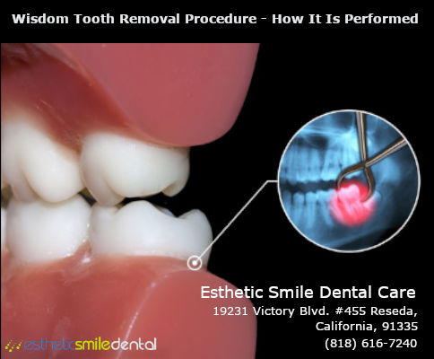 How Is Wisdom Tooth Removal Performed?